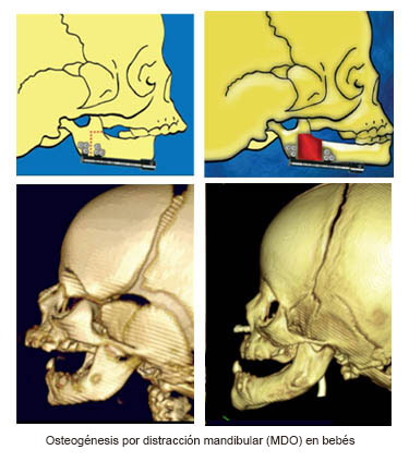https://cutecrateclub.store/SiteCollectionImages/Infant_Mandibular_Distraction_Osteogenesis_es.jpg