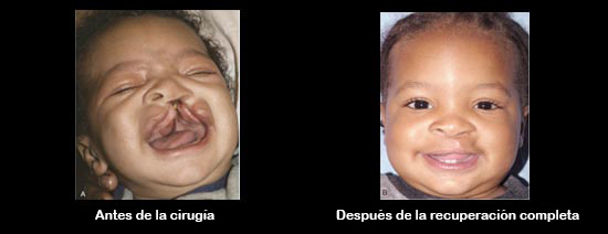 https://cutecrateclub.store/SiteCollectionImagesArticleImages/CleftbeforeAfter_Baby_es.jpg