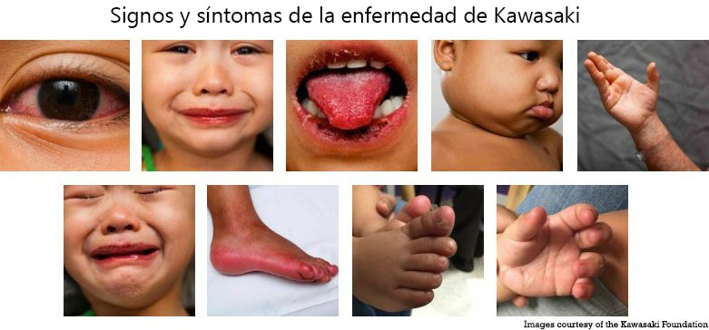 https://cutecrateclub.store/SiteCollectionImagesArticleImages/Signs_Symptoms_Kawasaki_Disease_es.jpg