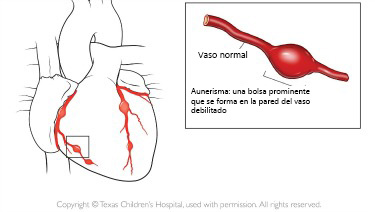 https://cutecrateclub.store/SiteCollectionImagesArticleImages/aneurysm_texaschildrens_es.jpg