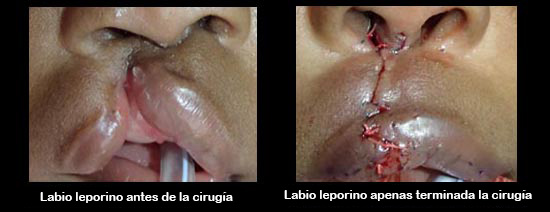 https://cutecrateclub.store/SiteCollectionImagesArticleImages/cleftLipBeforeAfter2_es.jpg